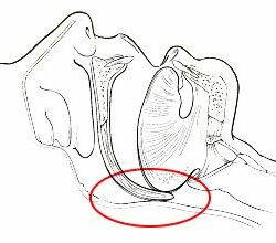 Schlafapnoe wegen eines verschlossenen Atemweges